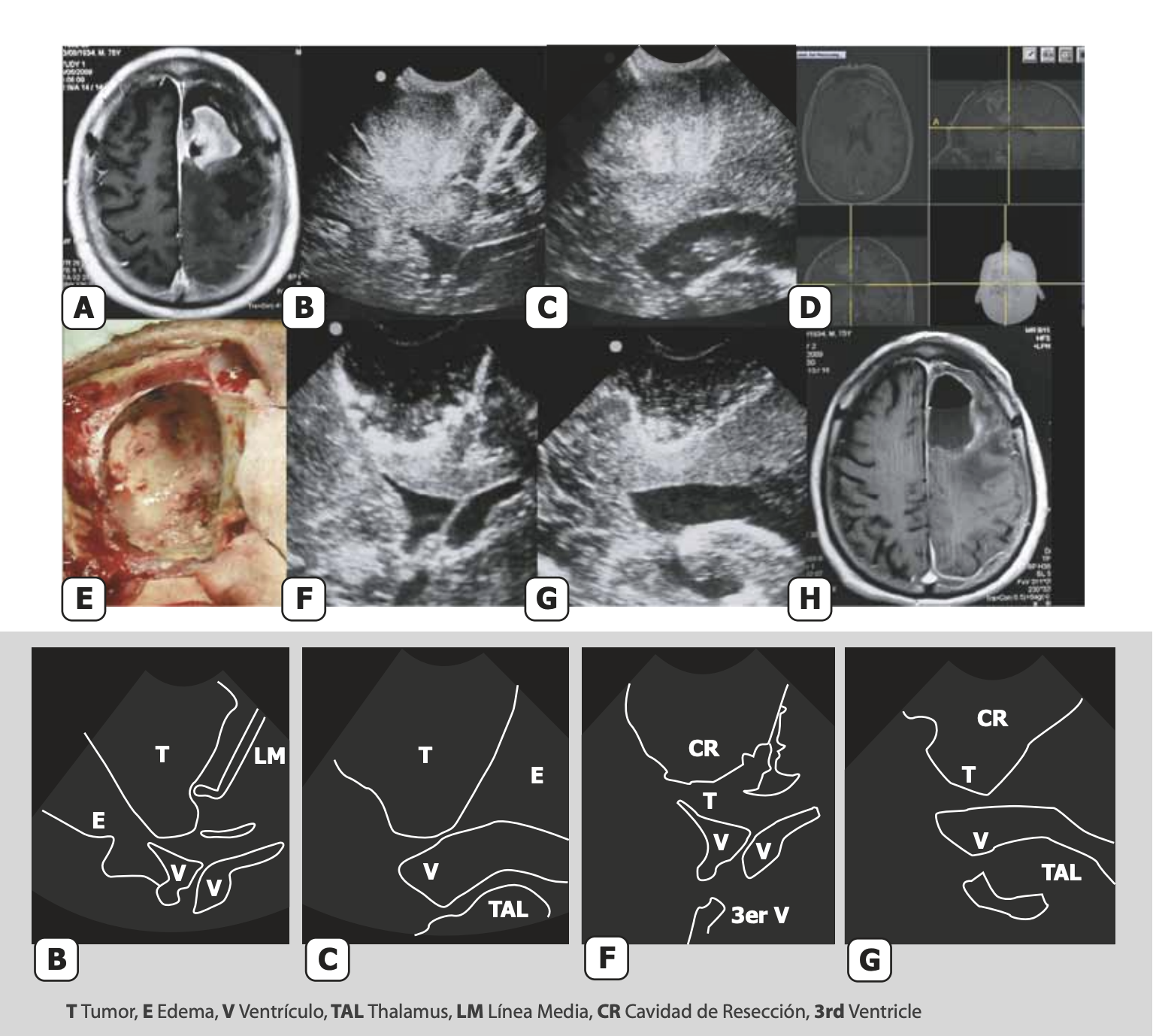 Atlas de Ultrasonografía Intraoperatoria en Neurocirugía: Descarga Gratuita